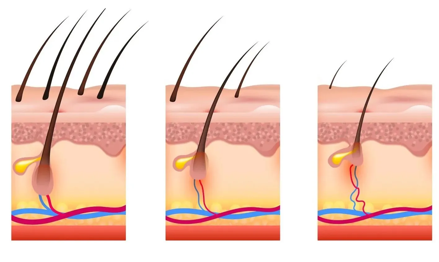 Laserbehandlung